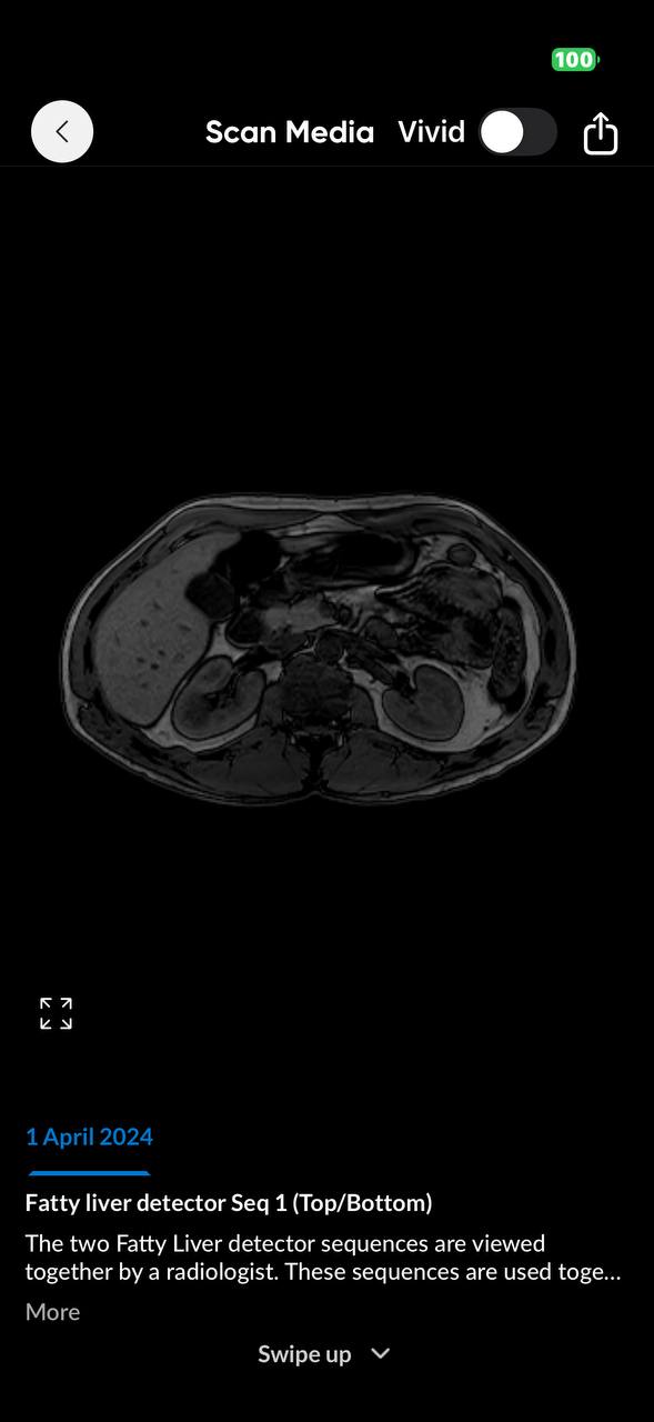 Liver 1