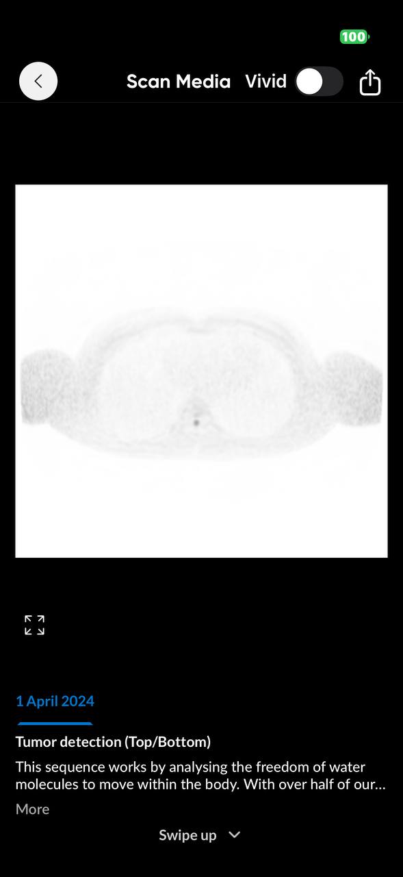 Tumor